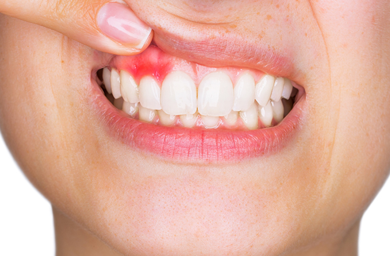 Waspada Penyakit Periodontal !